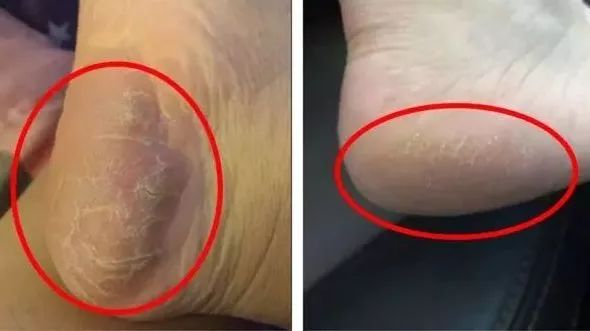脚后跟套上这个“*钟金**罩”夏季穿鞋嫩到反光!干裂、老茧、死皮都没了!