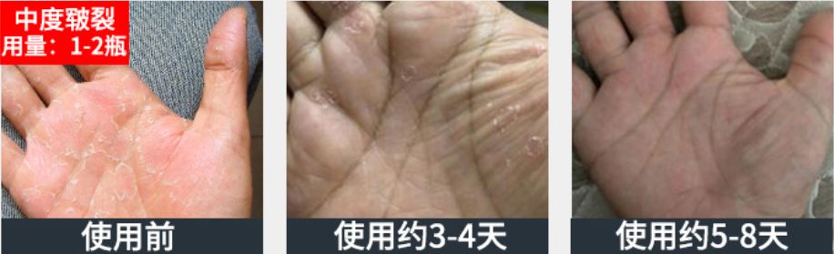 脚后跟套上这个“*钟金**罩”夏季穿鞋嫩到反光!干裂、老茧、死皮都没了!