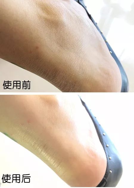 脚后跟套上这个“*钟金**罩”夏季穿鞋嫩到反光!干裂、老茧、死皮都没了!