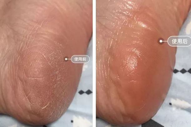 脚后跟套上这个“*钟金**罩”夏季穿鞋嫩到反光!干裂、老茧、死皮都没了!