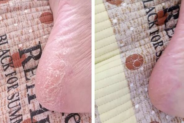 脚后跟套上这个“*钟金**罩”夏季穿鞋嫩到反光!干裂、老茧、死皮都没了!