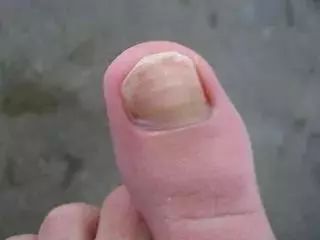 六种被误认为灰指甲的疾病,得了灰指甲最忌讳的是什么