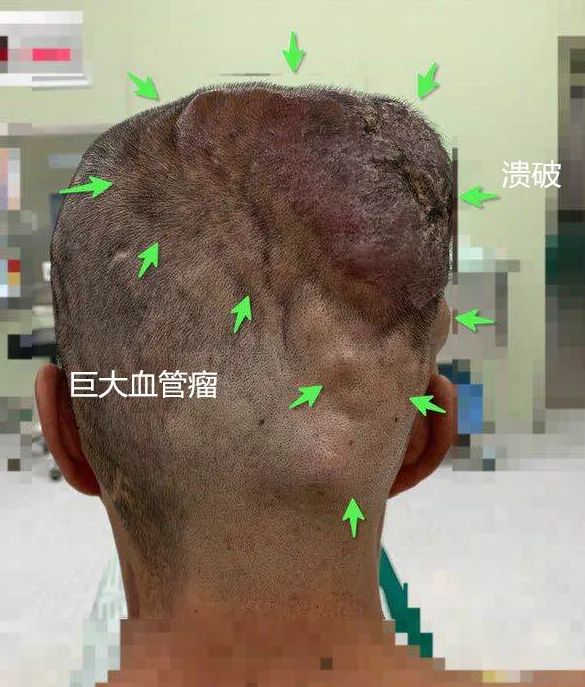 清华长庚血管外科,北京清华长庚医院治疗脑肿瘤好吗