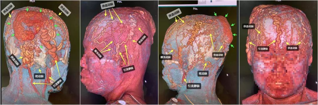 清华长庚血管外科,北京清华长庚医院治疗脑肿瘤好吗