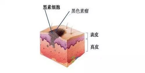 黑痣长在身上2个部位特容易癌变,什么位置的黑痣容易癌变
