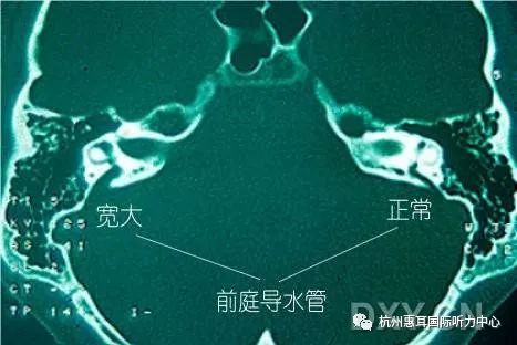 听力损失的科普文章,儿童听力损失测听科普