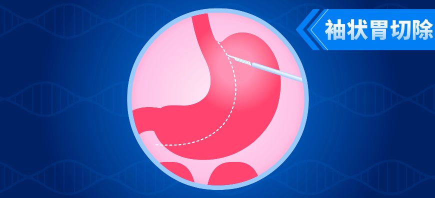 切胃真的能瘦吗,切胃减肥不就是节食吗