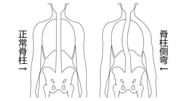 站姿不对会出现脊柱侧弯,坐姿不正确导致脊柱侧弯视频