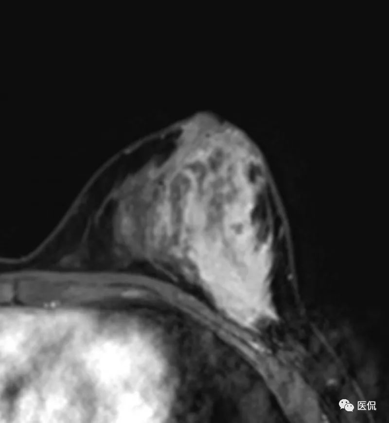 先天性乳头凹陷，MRI发现炎性病变，怎么诊断？