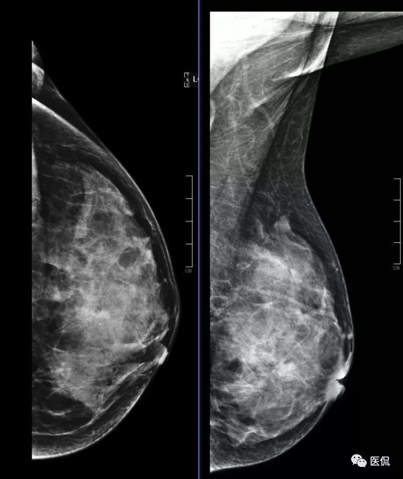 先天性乳头凹陷，MRI发现炎性病变，怎么诊断？