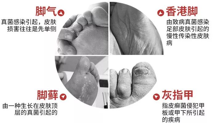 脚气脚臭脱皮克星,分享一个根治脚气脚臭方法