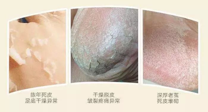 脚气脚臭脱皮克星,分享一个根治脚气脚臭方法