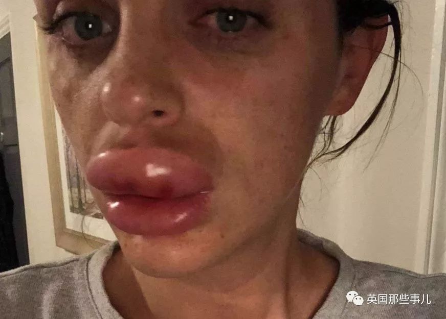 丰唇后肿成香肠嘴过几天会消失吗,在朋友家里玩香肠派对