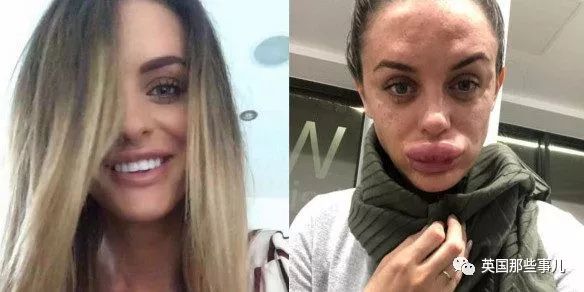 丰唇后肿成香肠嘴过几天会消失吗,在朋友家里玩香肠派对