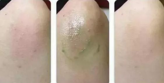 止痒消肿蚊虫膏泰国,泰国防蚊子药膏