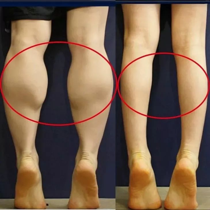 【精选好物】滚一滚,全身缩水小一圈!明星都爱的淋巴按摩仪,滚出小蛮腰、小V脸