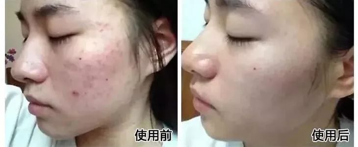 【精选好物】滚一滚，全身缩水小一圈！明星都爱的淋巴按摩仪，滚出小蛮腰、小V脸