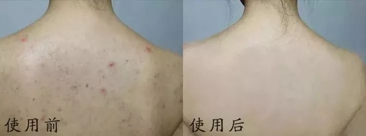 【精选好物】滚一滚,全身缩水小一圈!明星都爱的淋巴按摩仪,滚出小蛮腰、小V脸