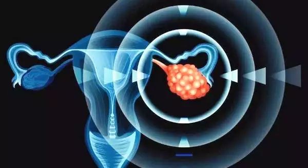 巧克力囊肿是卵巢囊肿吗,巧克力囊肿可以吃巧克力吗