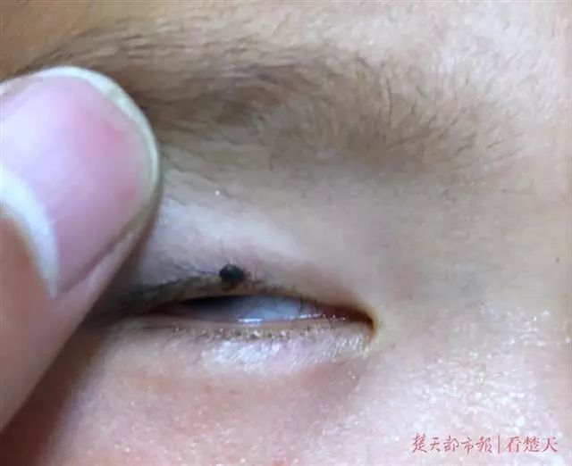 眼皮上长了个凸起小疙瘩有小黑点,2岁下眼皮忽然有个小黑点