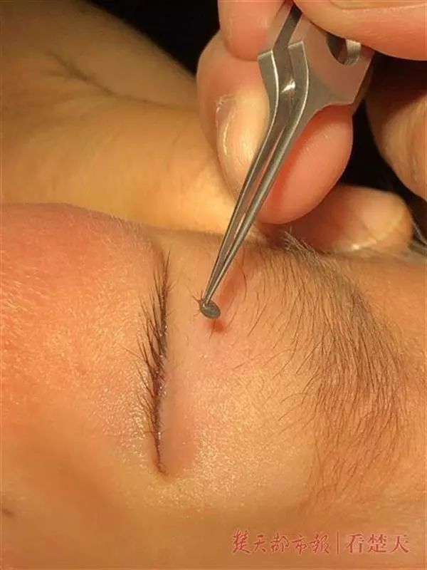 眼皮上长了个凸起小疙瘩有小黑点,2岁下眼皮忽然有个小黑点