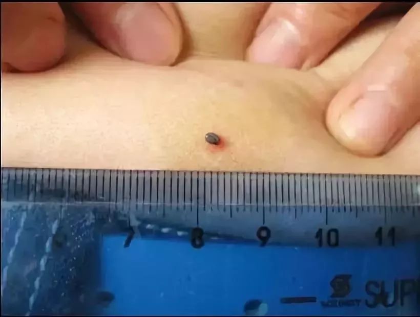 眼皮上长了个凸起小疙瘩有小黑点,2岁下眼皮忽然有个小黑点