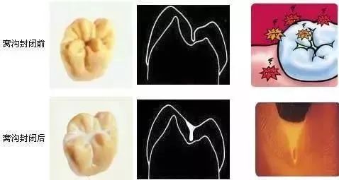 儿童换牙期牙周炎怎么治疗,蛀牙了怎么预防牙周炎