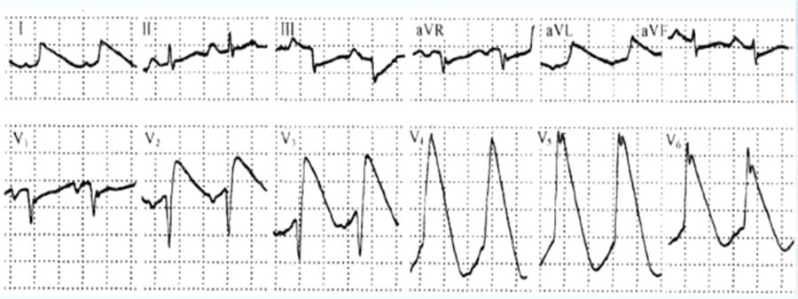 胸痛心电图表现,胸痛的心电图鉴别诊断