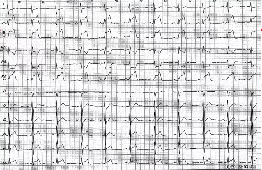 胸痛心电图表现,胸痛的心电图鉴别诊断