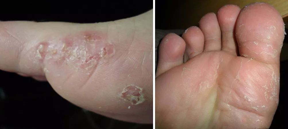 去脚臭的足皂,防脚臭洗脚皂