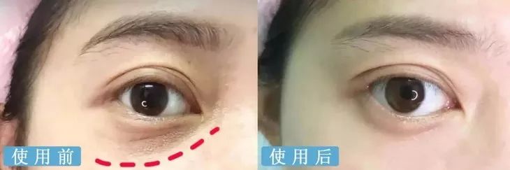 德国变态震动棒，啪啪啪间抚平眼袋、黑眼圈！不用开刀，就能让你年轻十岁！