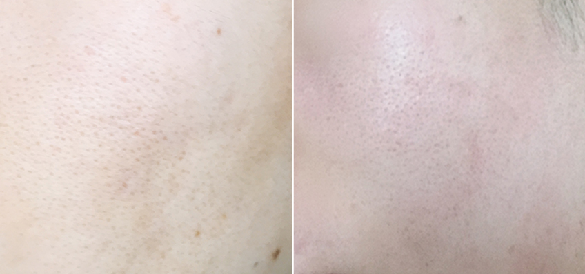 头痒脸干痒,季节性过敏眼痒鼻炎