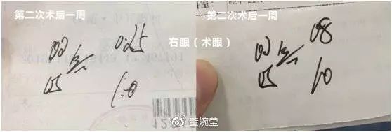 华西整形科斜视,华西眼科斜视手术多少钱