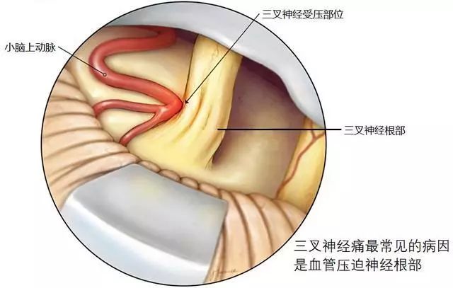 北京天坛医院三叉神经痛专家,天坛医院三叉神经手术费用