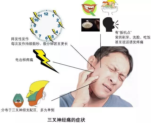 北京天坛医院三叉神经痛专家,天坛医院三叉神经手术费用