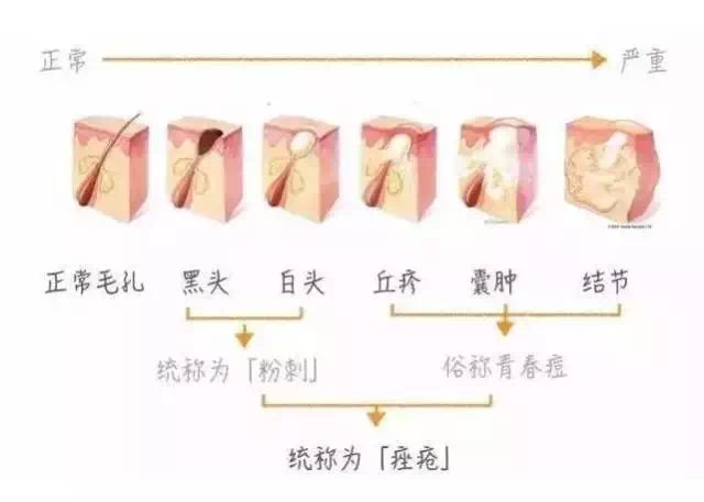 祛痘药膏指南,国内祛痘绝招排名榜最新