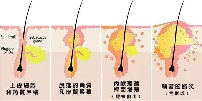 祛痘药膏指南,国内祛痘绝招排名榜最新