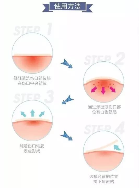 祛痘药膏指南,国内祛痘绝招排名榜最新