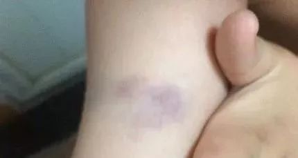 注意|身上出现淤青怎么办？这４种情况别大意