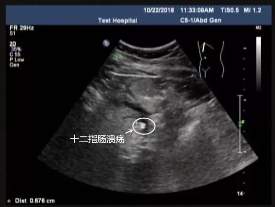 刚做完胃镜能做胃超声吗,友谊消化科普