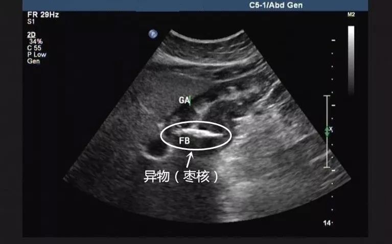 刚做完胃镜能做胃超声吗,友谊消化科普