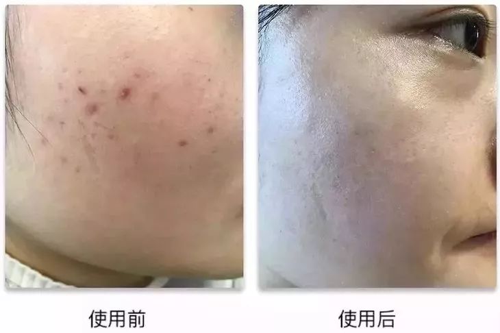 螨虫在脸上爬好不好,螨虫爬过的东西还能用吗