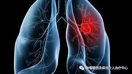 介入微创治肿瘤,微创肿瘤消融术治疗肺癌