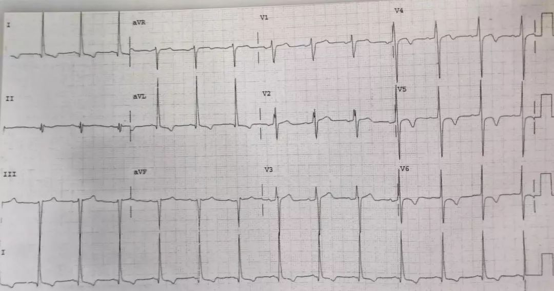 st压低t波倒置严重吗,st段压低和t波倒置