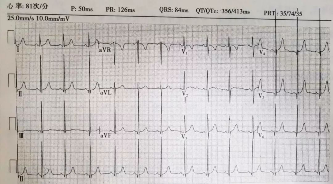 st压低t波倒置严重吗,st段压低和t波倒置