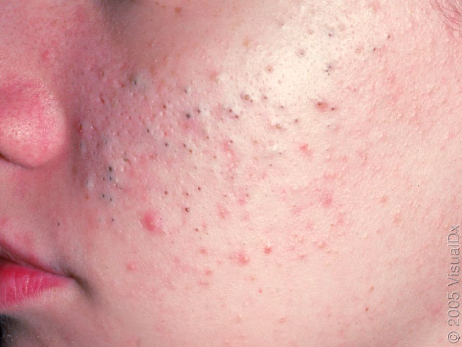 哪种皮肤病容易被误判为银屑病,容易被误诊为疥疮的皮肤病