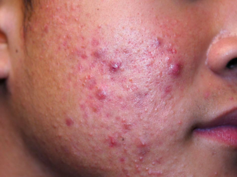 哪种皮肤病容易被误判为银屑病,容易被误诊为疥疮的皮肤病