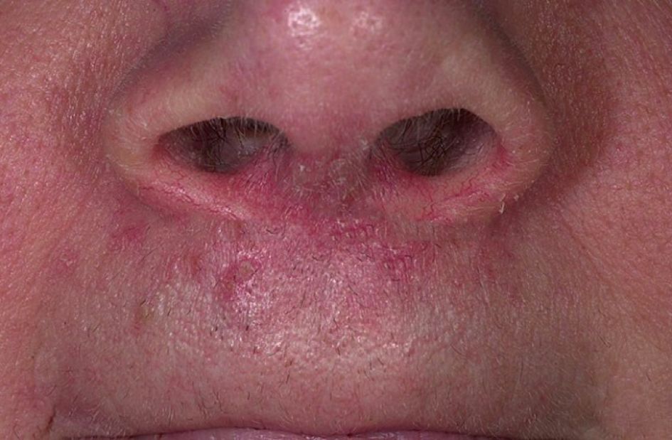 哪种皮肤病容易被误判为银屑病,容易被误诊为疥疮的皮肤病