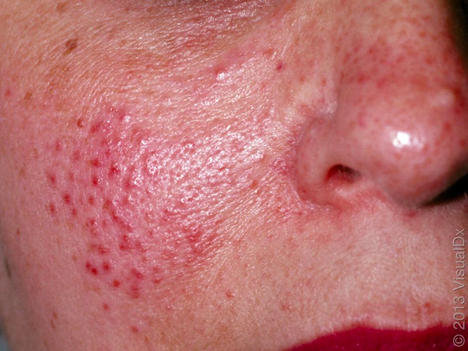 哪种皮肤病容易被误判为银屑病,容易被误诊为疥疮的皮肤病