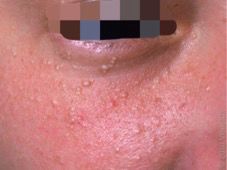 哪种皮肤病容易被误判为银屑病,容易被误诊为疥疮的皮肤病